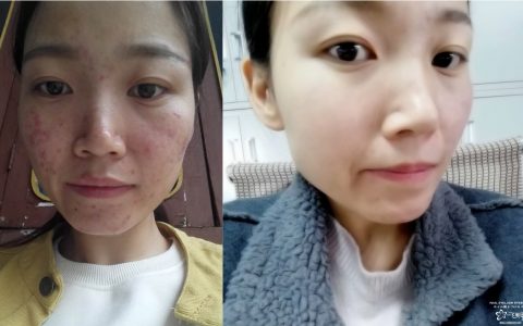 排毒去痘 5種食物快速排毒祛痘