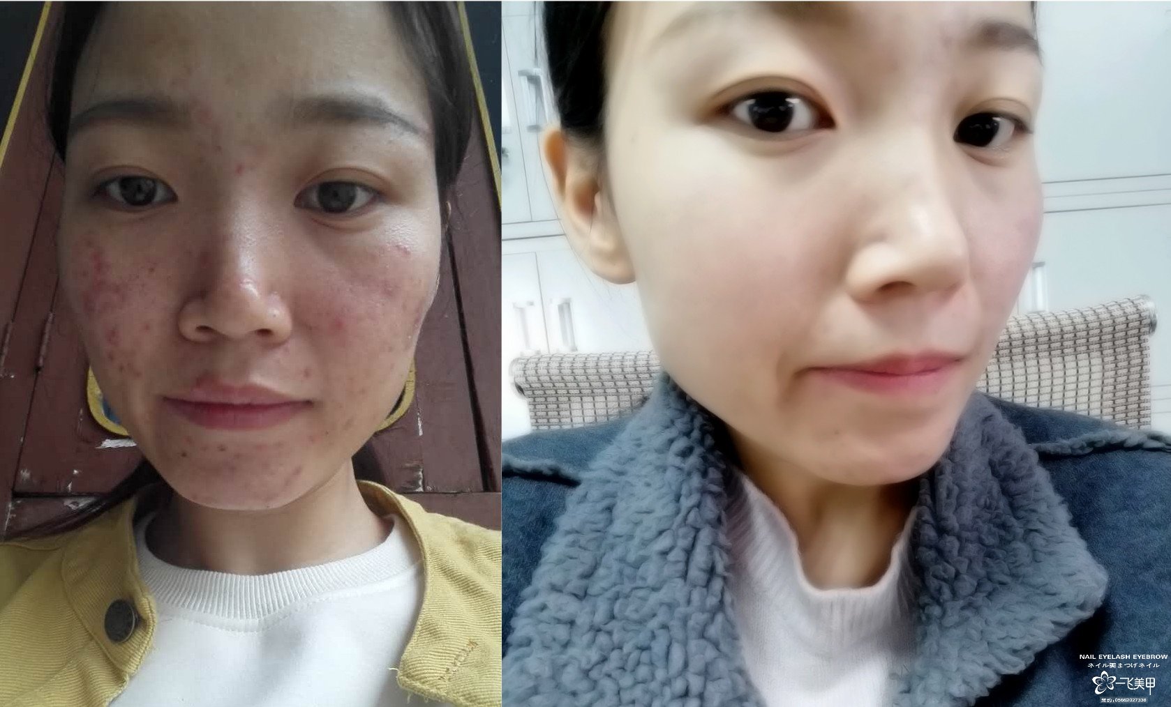 排毒去痘 5種食物快速排毒祛痘