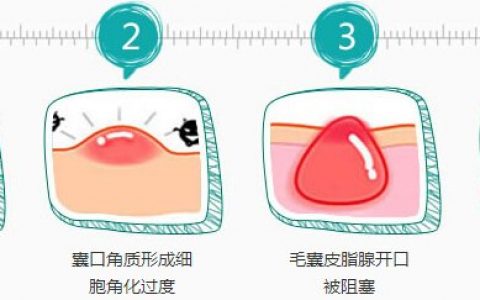 中醫(yī)治療痘痘 老中醫(yī)教你如何去除痘痘
