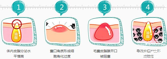 中醫(yī)治療痘痘 老中醫(yī)教你如何去除痘痘