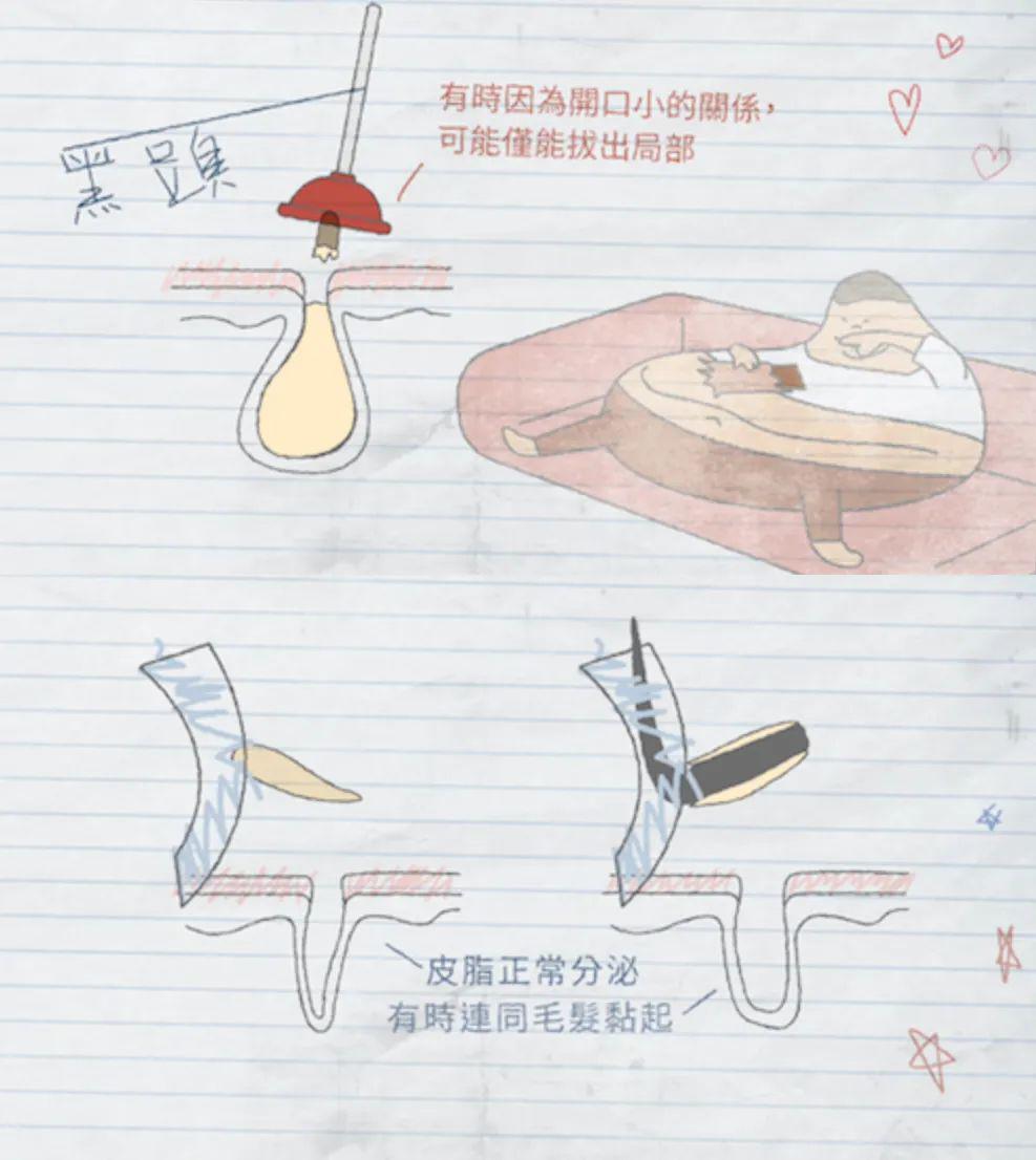 去黑頭最全攻略！一篇告訴你黑頭怎么去除最有效！