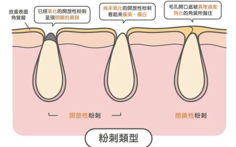 去黑頭最全攻略！一篇告訴你黑頭怎么去除最有效！
