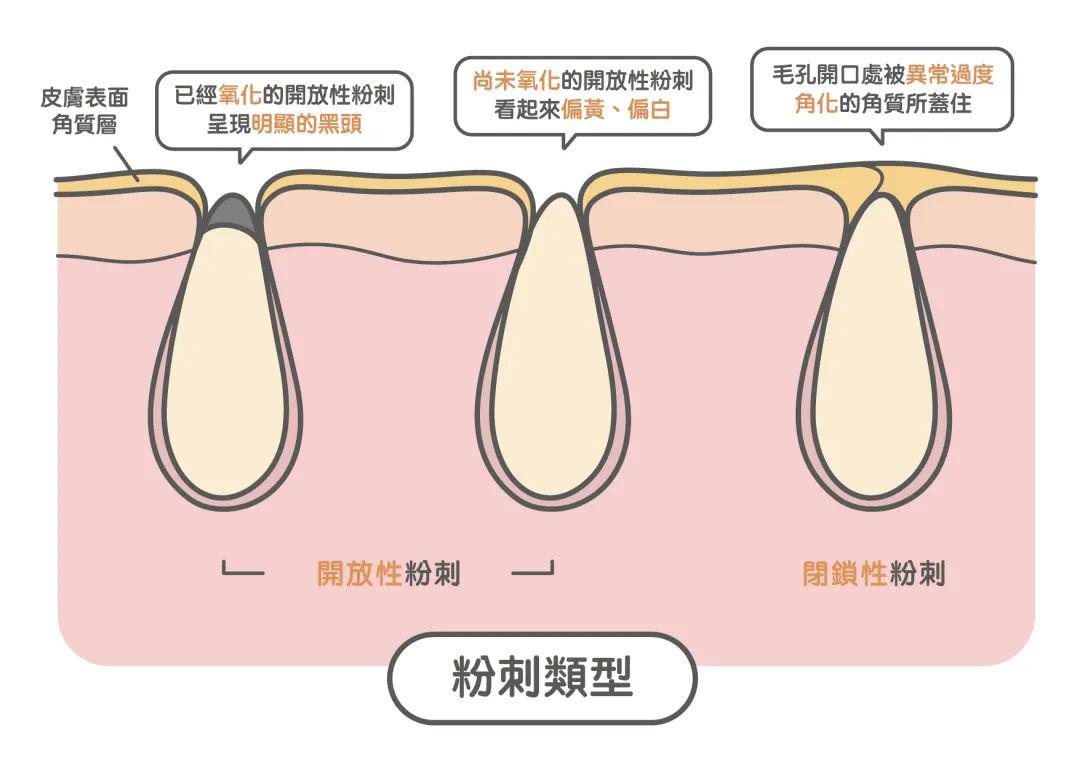 去黑頭最全攻略！一篇告訴你黑頭怎么去除最有效！