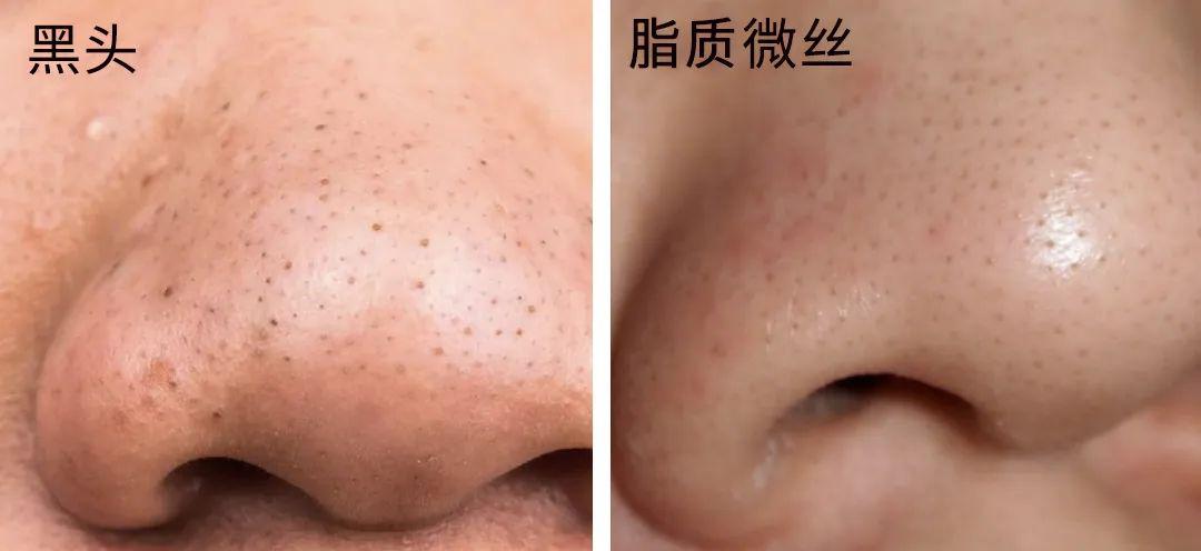 去黑頭最全攻略！一篇告訴你黑頭怎么去除最有效！