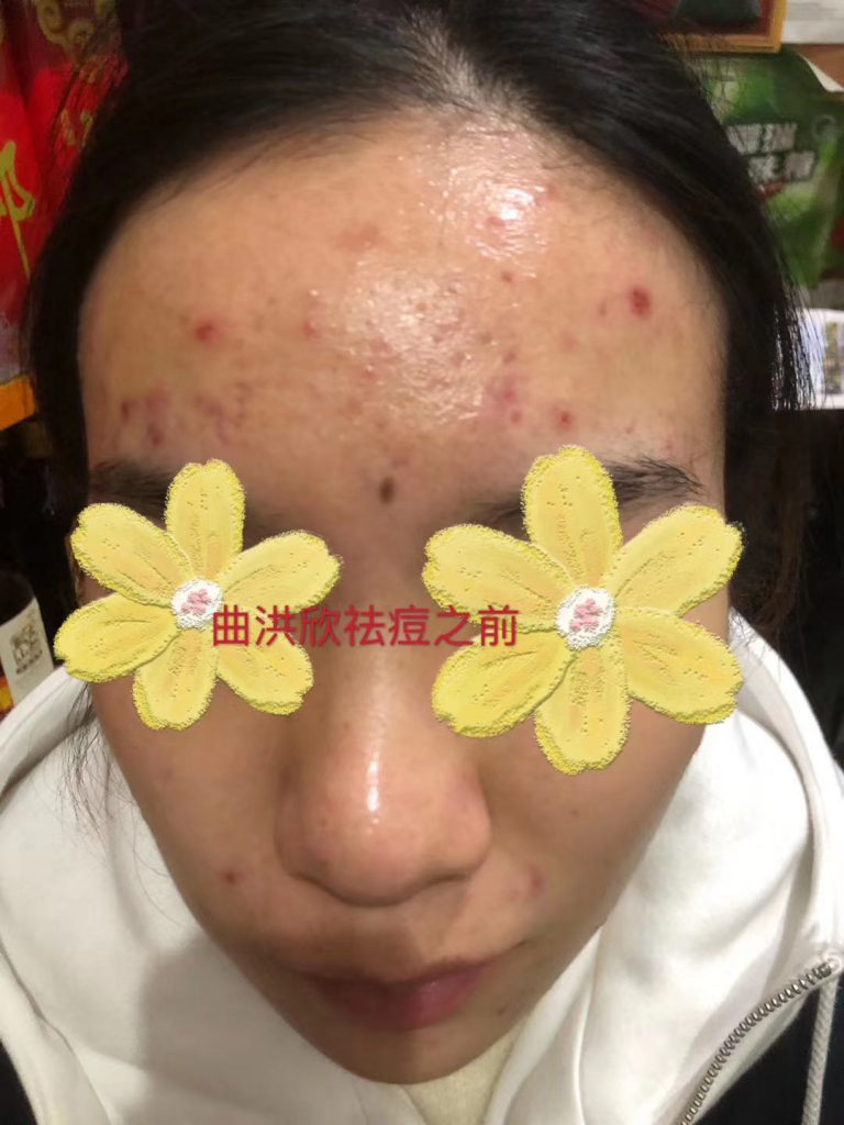 痘痘的病因有哪些？為什么會長痘？