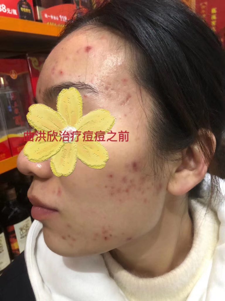 痘痘的病因有哪些？為什么會長痘？