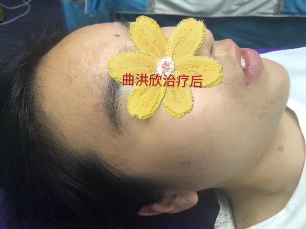 痘痘的病因有哪些？為什么會長痘？