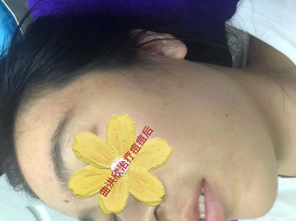 痘痘的病因有哪些？為什么會長痘？