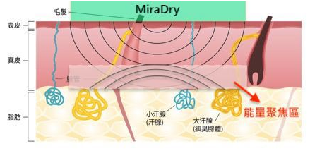 miraDry清新微波：腋臭基因到底有多強(qiáng)大，看看這些內(nèi)容就知道