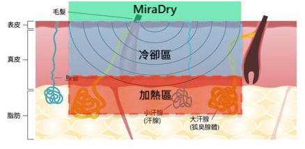 miraDry清新微波：腋臭基因到底有多強(qiáng)大，看看這些內(nèi)容就知道