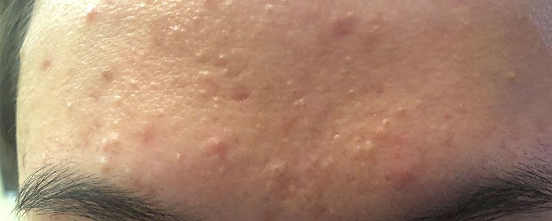 涂水乳要避開(kāi)痘痘嘛