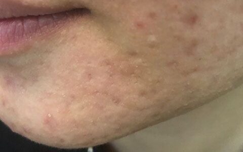 挑痘痘之后要怎么護(hù)理