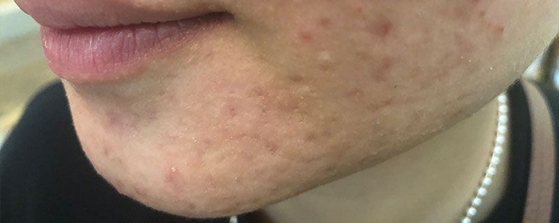 挑痘痘之后要怎么護(hù)理