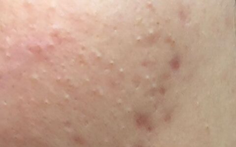 如何拯救痘痘臉
