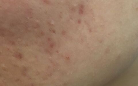 臉上黑印怎么快速消除