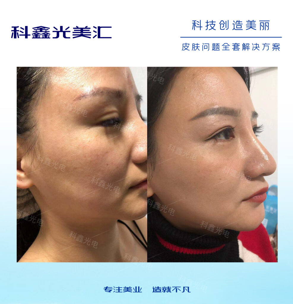 做完點(diǎn)陣激光術(shù)后怎么修復(fù)和護(hù)理？