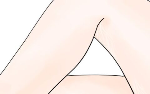 大腿生長紋怎么去除