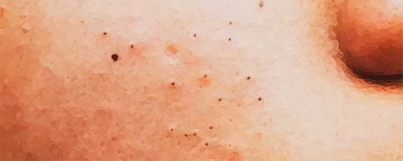 閉口粉刺不美觀，怎么才能避免